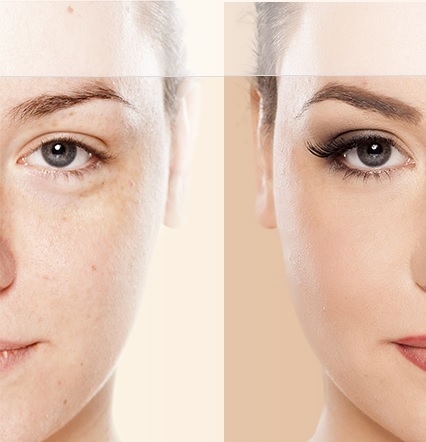 Akne ve Leke Tedavisi